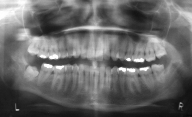 Dental X-rays Overview